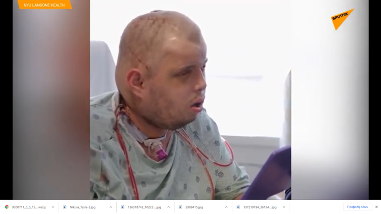 «Μου έδωσαν πίσω τη ζωή μου»: Ο πυροσβέστης που υποβλήθηκε στην πληρέστερη μεταμόσχευση προσώπου μετά από πυρκαγιά(βίντεο)