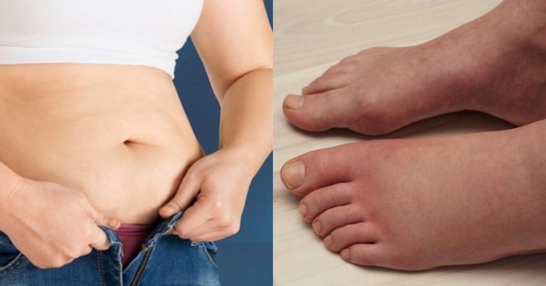 Κατακράτηση υγρών: Ποιες είναι οι αιτίες και τι πρέπει να τρώω