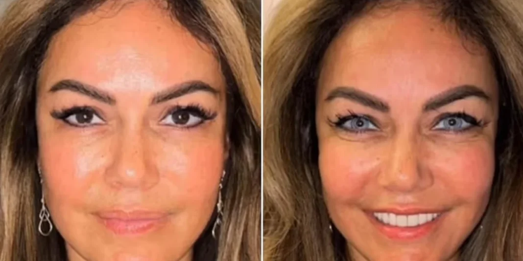 Νέα μόδα: Αλλαγή χρώματος ματιών με χειρουργική επέμβαση – rpn