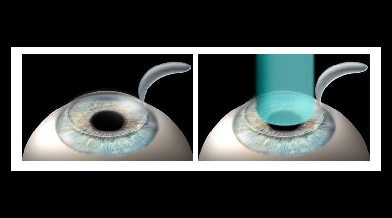 Έρχεται ασφαλέστερη και φθηνότερη μέθοδος διόρθωσης μυωπίας και πρεσβυωπίας