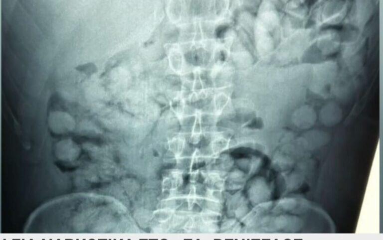 Σπάτα: Αλλοδαπός κατάπιε 100 «αυγά» με κοκαΐνη – Οι ακτινογραφίες αποκάλυψαν την αλήθεια- rpn