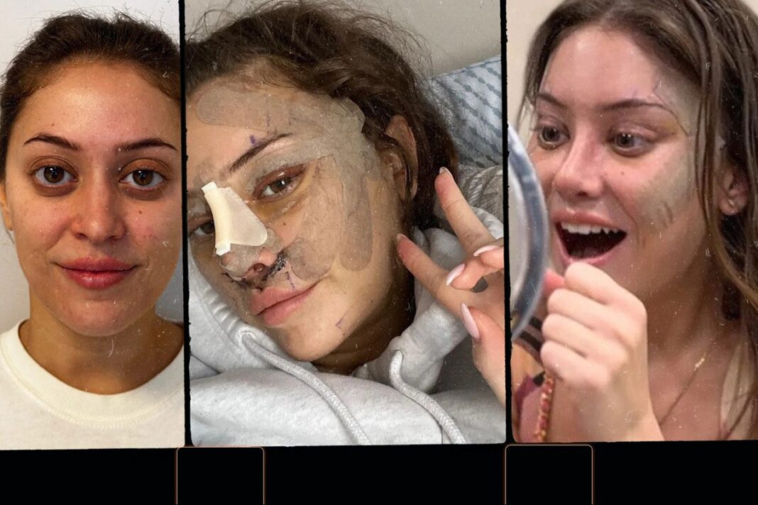 Λίφτινγκ στα 28: Γιατί η γενιά του Instagram στρέφεται στο νυστέρι; Η άνοδος, η προειδοποίηση, η ανησυχία