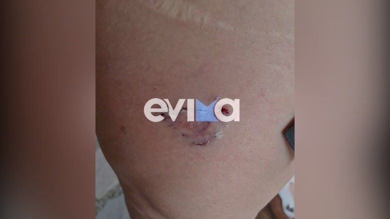 Εύβοια: Σκύλος επιτέθηκε σε λουόμενους στο Λευκαντί – Τρεις τραυματίες